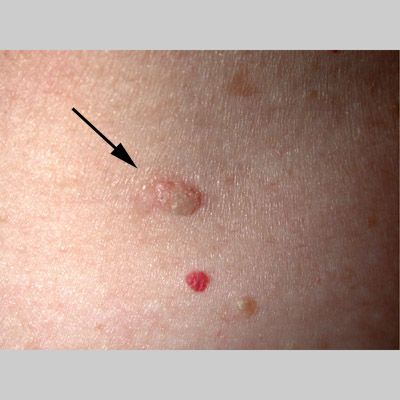 Benign Cystic Skin Lesions