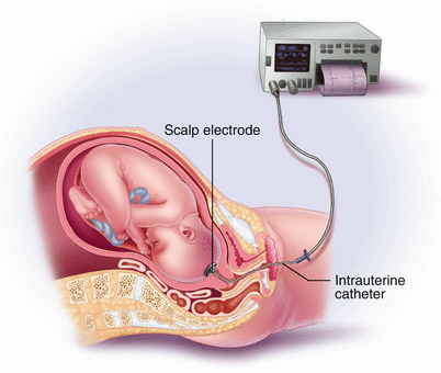 Fetal Monitoring: Techniques and Their Importance