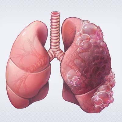 Respiratory Emergencies: Life-Saving Interventions