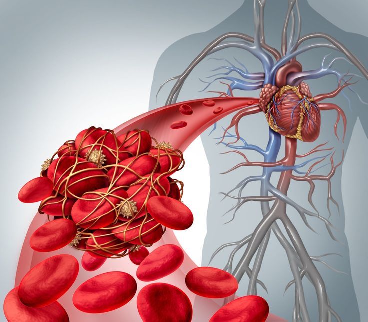 Coagulation Disorders: An Overview of Common Conditions