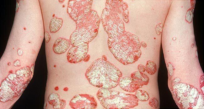 Psoriasis: An Overview