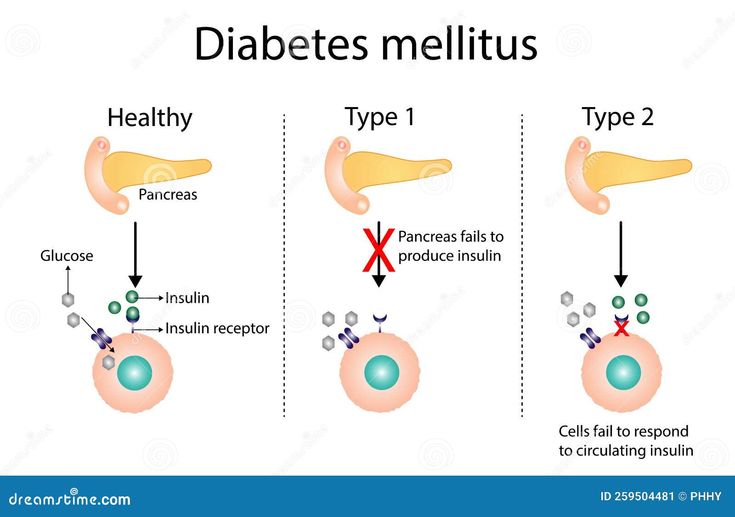 Diabetes Mellitus – Types, Diagnosis, and Management